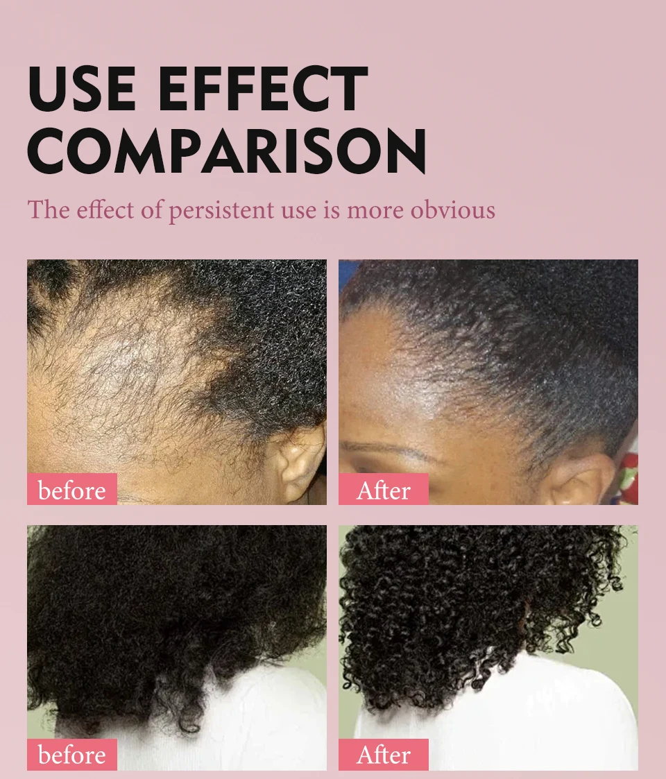 Fast Hair Growth Set Batana Oil Traction Alopecia HairS Mask Anti Break Loss Hair Growth Oil Baldness Treatment Hair Health Care 13 S2b9c1df3315f4ea2a2ee13534e514ffaB