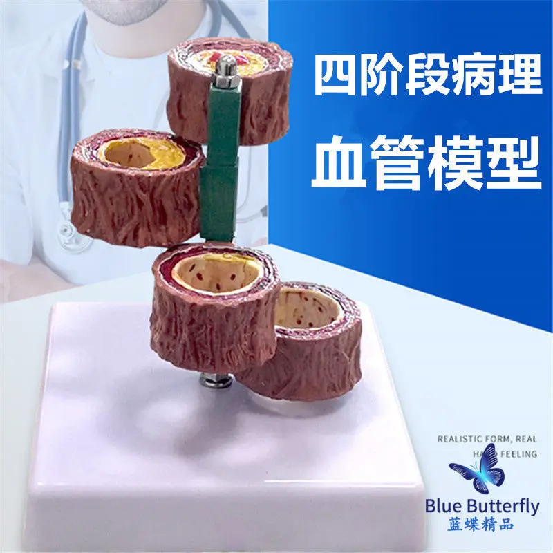 Blockage of blood vessels, blood concentration, fat pathology, blood, human vascular pathology, anatomical model
Blockage of blood vessels, blood concentration, fat pathology, blood, human vascular pathology, anatomical model
