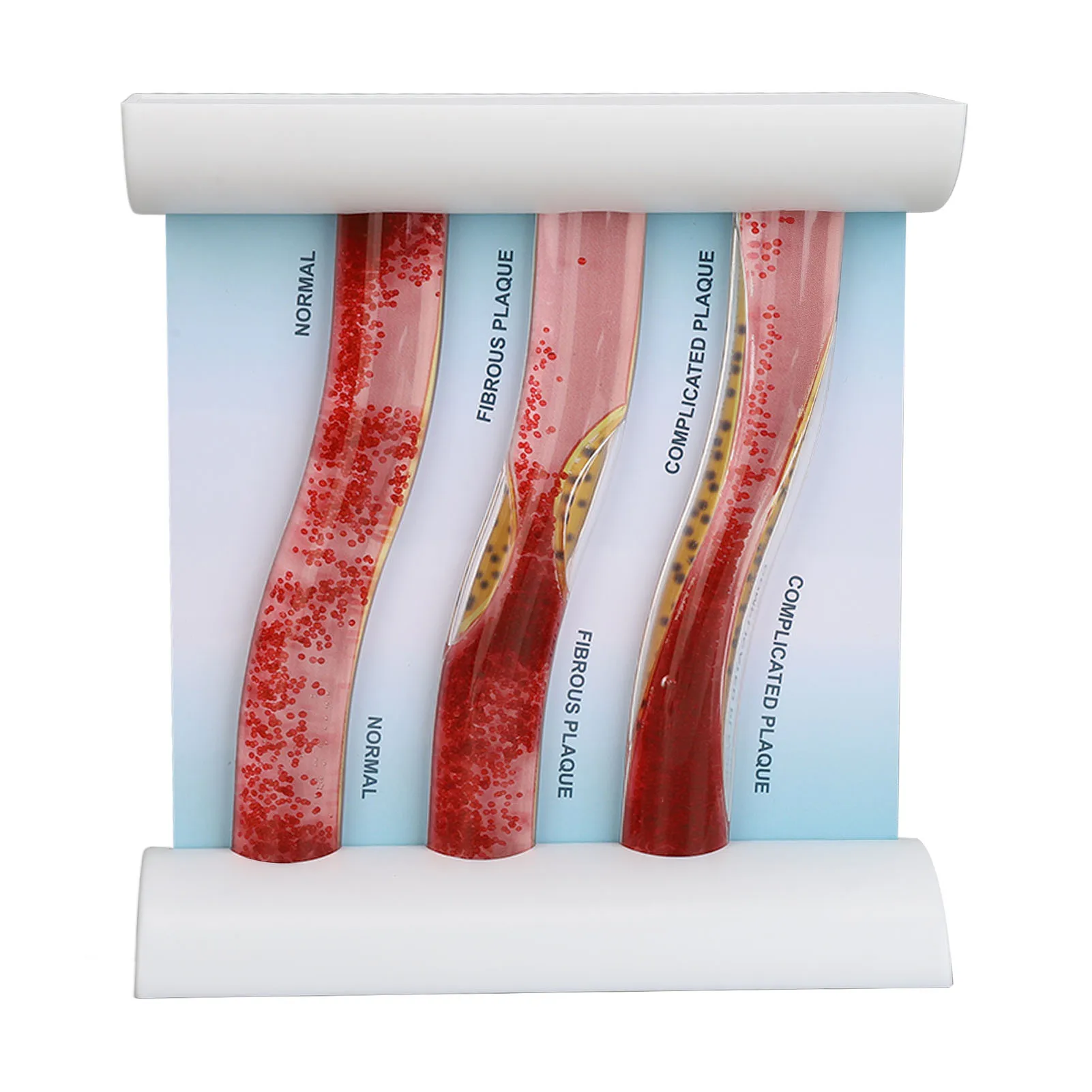 Low Density Lipoprotein Vessel Model Lipoprotein LDL Vessel Model Low Density Lipid Vessel Obstruction Model for Education
Low Density Lipoprotein Vessel Model Lipoprotein LDL Vessel Model Low Density Lipid Vessel Obstruction Model for Education