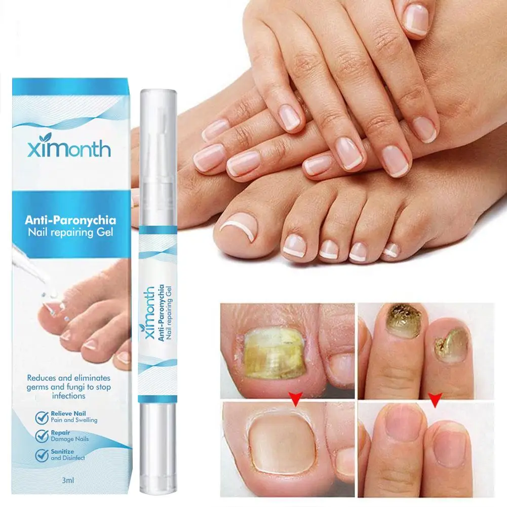Paronychia Treatment Gel Ingrown Toenail Removal Repair Anti Fungus Thickening Nails Nail Care Infection Grey Gel Restorati Q0A2
Paronychia Treatment Gel Ingrown Toenail Removal Repair Anti Fungus Thickening Nails Nail Care Infection Grey Gel Restorati Q0A2