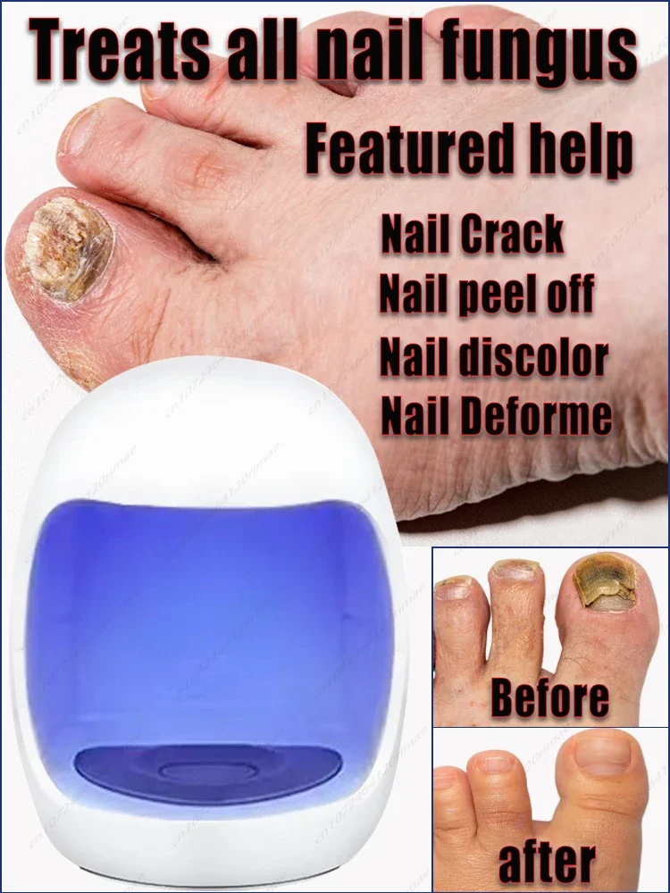 Nail Repair1 Foot Care2 Toenail Fungus3 Onychomycosis4 Foot Fungus5 Laser Nail Fungus Treatment6 Nail Repair
Nail Repair1 Foot Care2 Toenail Fungus3 Onychomycosis4 Foot Fungus5 Laser Nail Fungus Treatment6 Nail Repair