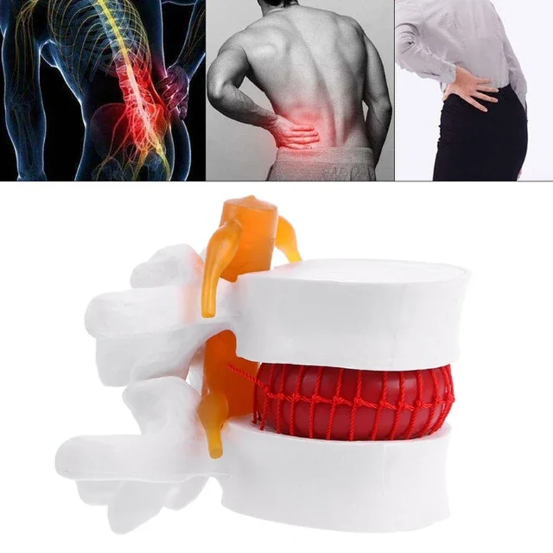 

Medical props model Human Anatomical Spine Lumbar Disc Herniation Model Anatomy Instrume Medical Learning Aid Tool