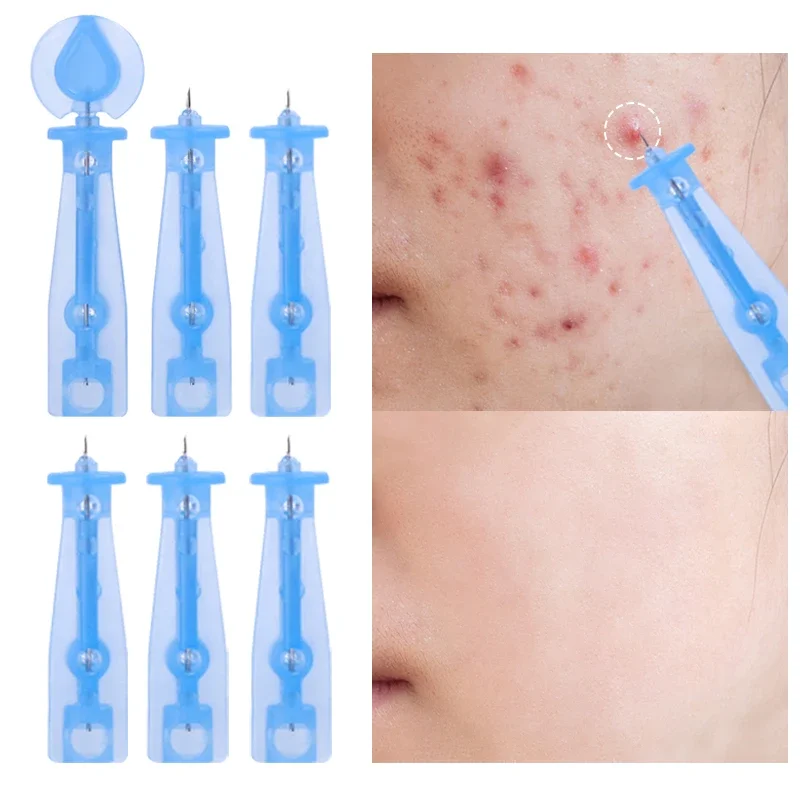 Disposable Acne Needle Mini Safe Deep Cleansing Blackhead Fat Grain Removal Beauty Skin Care Tool Face Clean Black Pore Needles
Disposable Acne Needle Mini Safe Deep Cleansing Blackhead Fat Grain Removal Beauty Skin Care Tool Face Clean Black Pore Needles