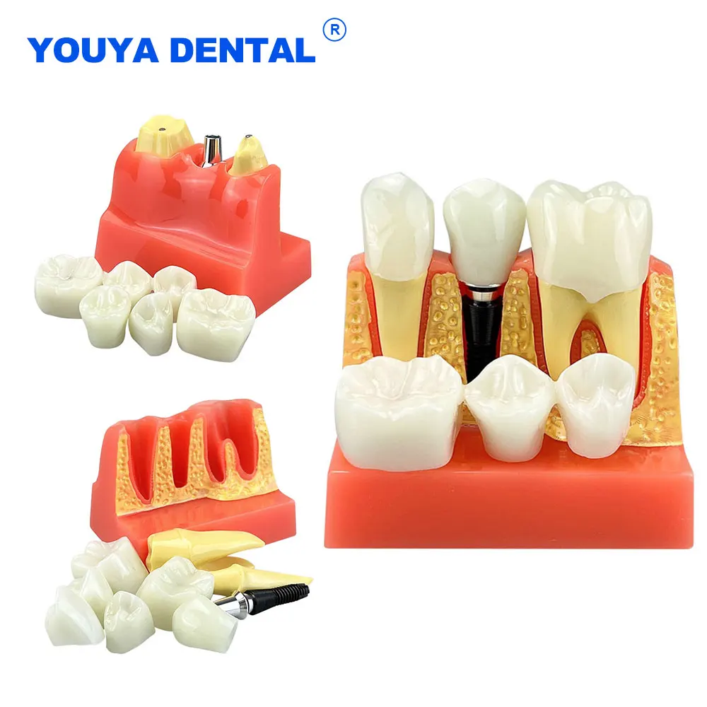 Зубной имплантат, модель 4 раза, демонстрационная модель, анализ короны, мост, медицинская наука, инструмент для обучения заболеваниям
Зубной имплантат, модель 4 раза, демонстрационная модель, анализ короны, мост, медицинская наука, инструмент для обучения заболеваниям