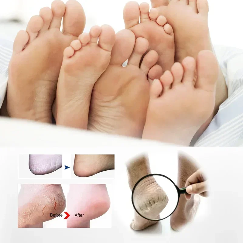 SdatterFoot spray exfoliates prevents skin itching dry crack feet Anti Fungal Beriberi antiperspirant deodorizes Moisturizes ca
SdatterFoot spray exfoliates prevents skin itching dry crack feet Anti Fungal Beriberi antiperspirant deodorizes Moisturizes ca