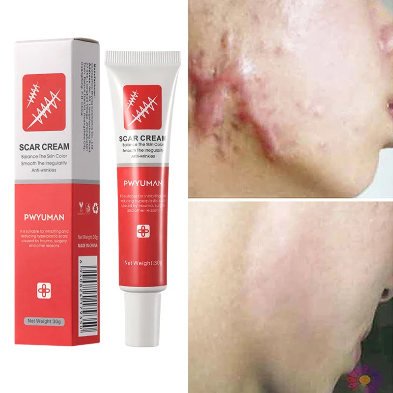 Scar Removal Cream Treatment Stretch Marks Acne Surgical Pimples Scars Gel Smooth Whitening No Stimulation Face Body Skin Care
Scar Removal Cream Treatment Stretch Marks Acne Surgical Pimples Scars Gel Smooth Whitening No Stimulation Face Body Skin Care
