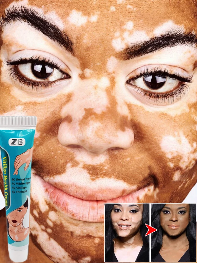 20g/pcs Removing vitiligo, pigmentation, reducing black spots, brightening the skin, daily care, white spot moisturizing crea
20g/pcs Removing vitiligo, pigmentation, reducing black spots, brightening the skin, daily care, white spot moisturizing crea