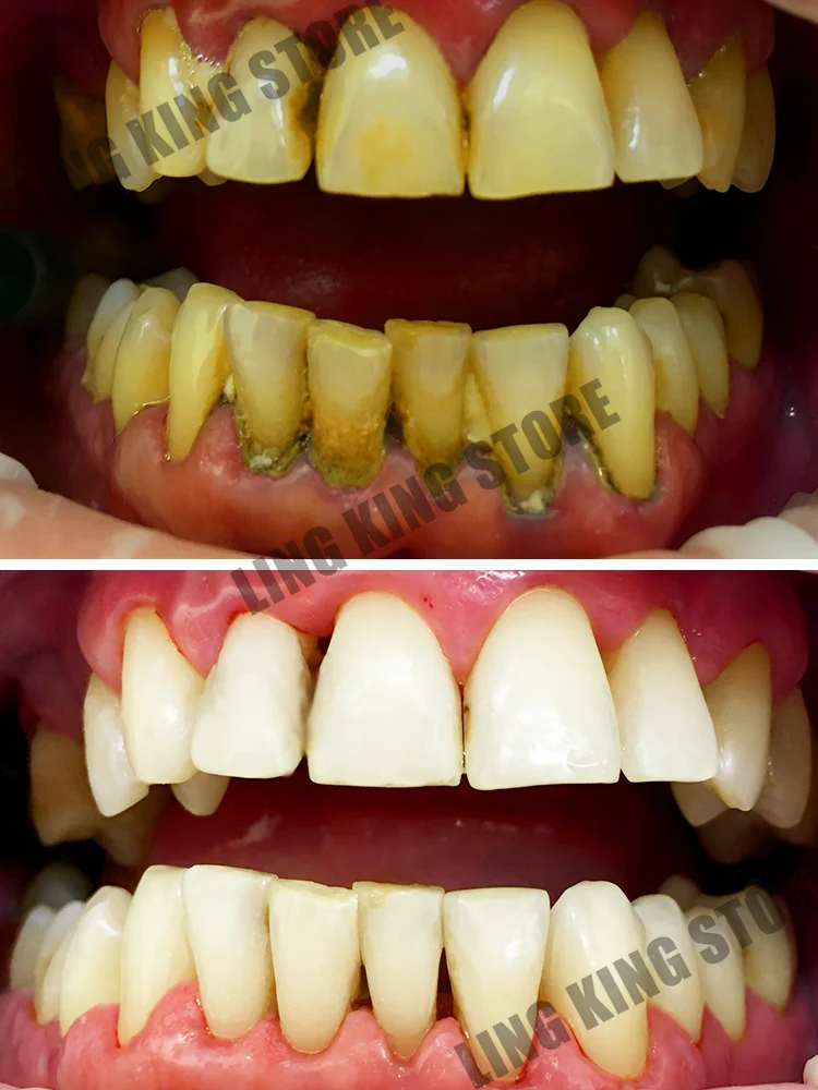 Tooth Stain Removal Periodontal Disease Treatment Relieve Toothache Whiten Teeth Remove Bad Breath
Tooth Stain Removal Periodontal Disease Treatment Relieve Toothache Whiten Teeth Remove Bad Breath
