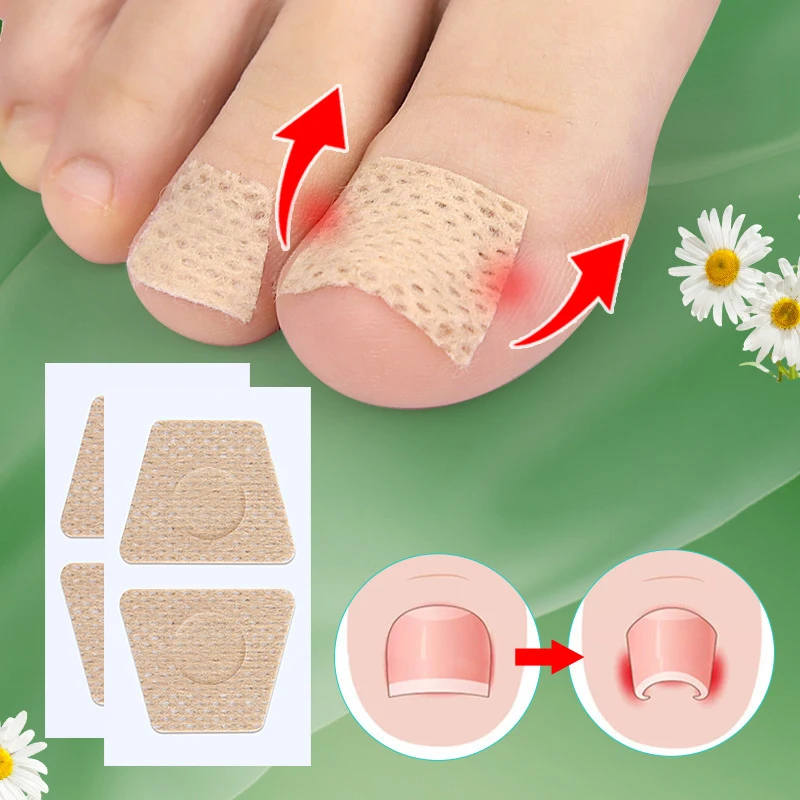 Nail Care Patch Ingrown Toenail Toe Pad Orthopedic Patch Soft Nail Onychomycosis Nail Repair Patch
Nail Care Patch Ingrown Toenail Toe Pad Orthopedic Patch Soft Nail Onychomycosis Nail Repair Patch