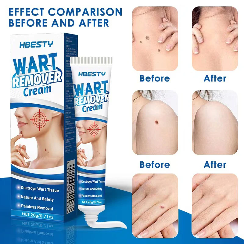 Skin Tag Removal Cream Removal Essential Oils Painless Mole Wart Removal Skin Melasma Serum Freckles Facial Wart Tag Treatment
Skin Tag Removal Cream Removal Essential Oils Painless Mole Wart Removal Skin Melasma Serum Freckles Facial Wart Tag Treatment