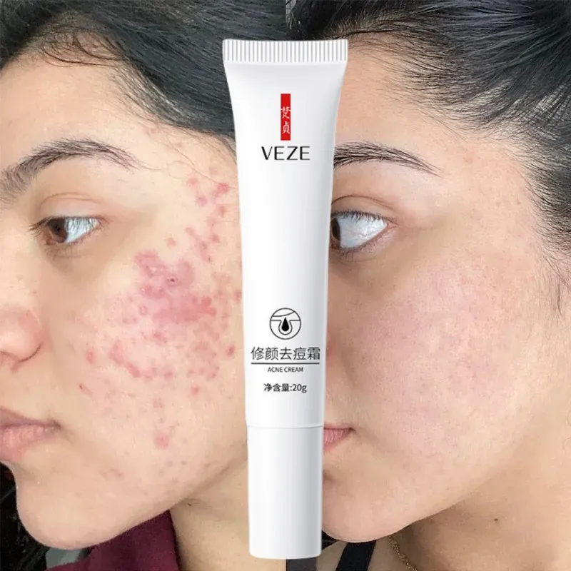 Powerful Acne Removal Cream Whitening Moisturizing Shrink Pores Oil Control Pimples Acne Treatment Gel Skin Care Korean Skincare
Powerful Acne Removal Cream Whitening Moisturizing Shrink Pores Oil Control Pimples Acne Treatment Gel Skin Care Korean Skincare