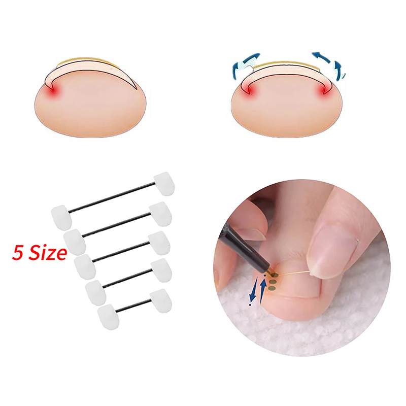 Professional Ingrown Toenail Correction Foot Care Tool Ingrown Toenail Corrector Tools Pedicure Recover Embed Toe Nail Treatment 
Professional Ingrown Toenail Correction Foot Care Tool Ingrown Toenail Corrector Tools Pedicure Recover Embed Toe Nail Treatment