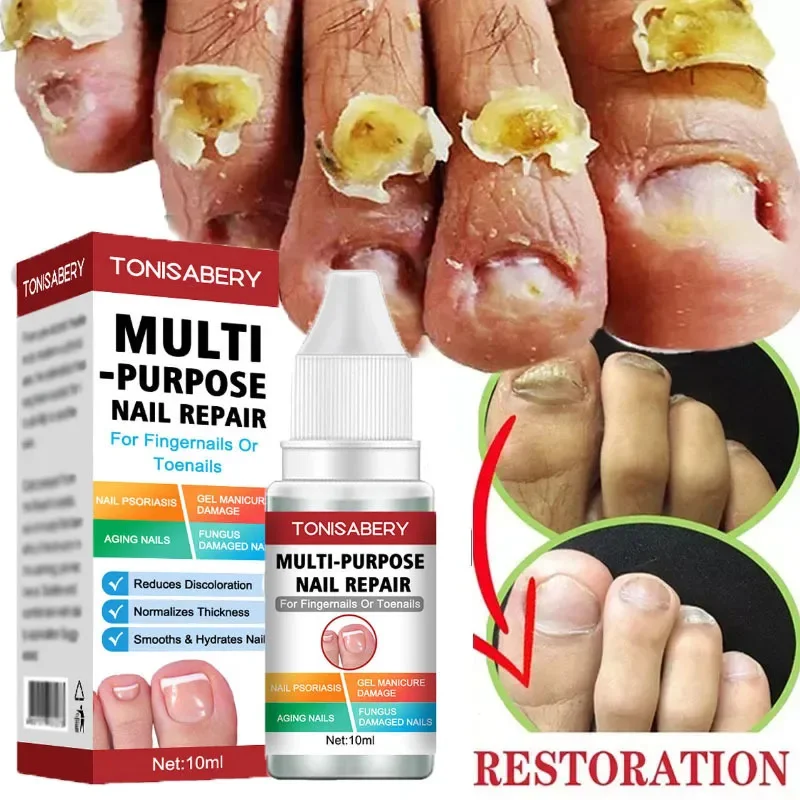 

Nail Fungal Treatment Serum Toe Nail Fungus Removal Essence Anti Infection Onychomycosis Paronychia Repair Gel Hand Foot Care