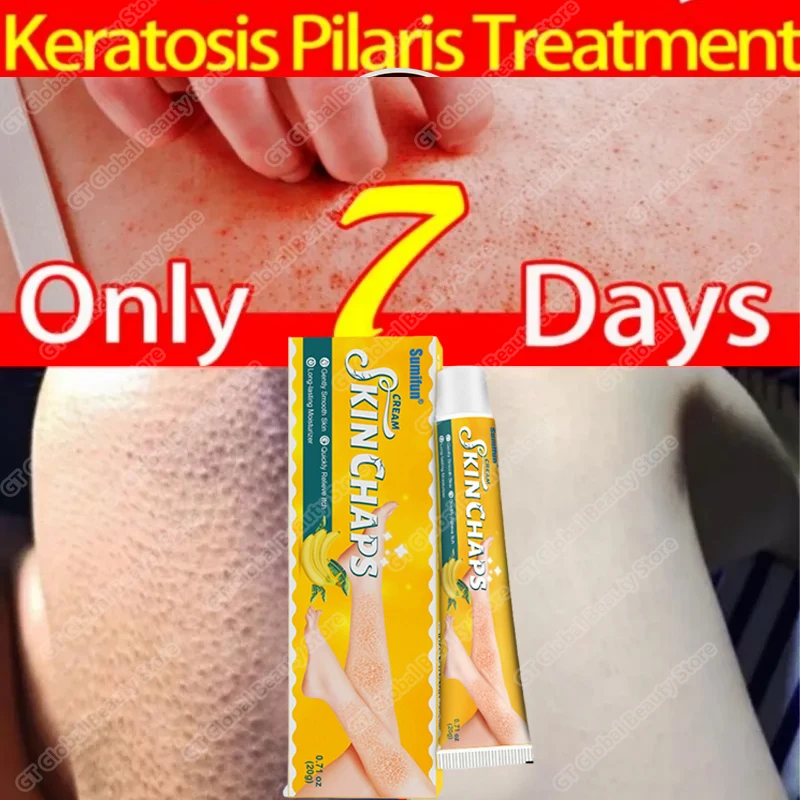 Removal Chicken Skin Cream Repair Dry Exfoliation Peeling Fish Scale Snake Skin Whitening Moisturizing Smooth Skin Care Products
Removal Chicken Skin Cream Repair Dry Exfoliation Peeling Fish Scale Snake Skin Whitening Moisturizing Smooth Skin Care Products