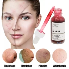 Ordinary AHA 30% + BHA 2% Peeling Solution 30ml The Powerful Resurfacing Treatment Works To Deeply Exfoliate Your Skin
Ordinary AHA 30% + BHA 2% Peeling Solution 30ml The Powerful Resurfacing Treatment Works To Deeply Exfoliate Your Skin