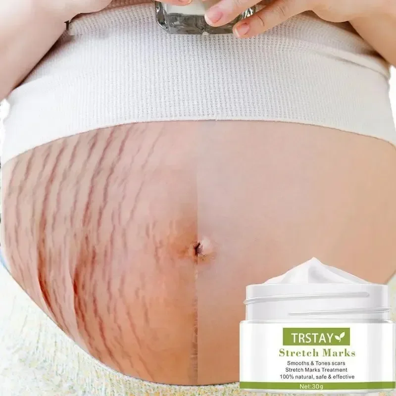 Stretch Marks Permanent Effective Removal Cream Firming Eliminate Body Belly Stretch Marks Swelling Marks Remove Skin Cracks
Stretch Marks Permanent Effective Removal Cream Firming Eliminate Body Belly Stretch Marks Swelling Marks Remove Skin Cracks