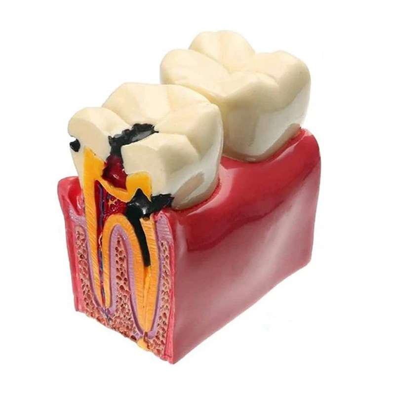 

Tooth Caries Model 6X Decay Model Oral Teeth Demonstration Teaching Model For Family School