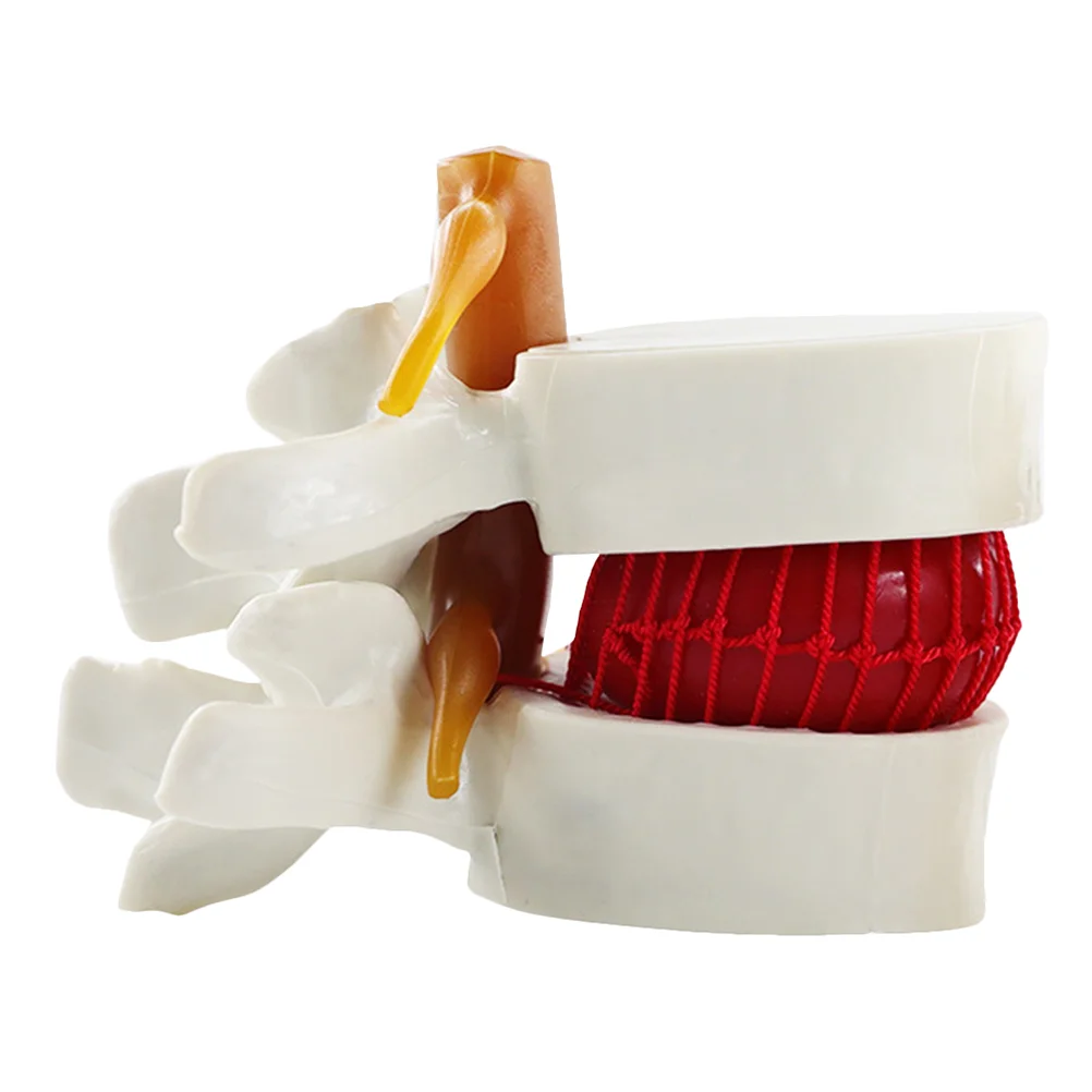 

Model Spine Lumbar Herniation Disc Human Models Anatomical Vertebrae Anatomy Vertebral Teaching Intervertebral Chiropractic