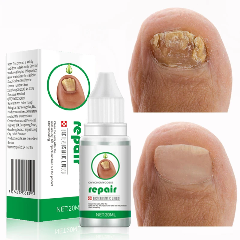 20ML Nail Fungus Treatment Serum Toe Fungal Repair Products Hand Foot Care Removal Gel Anti Infection Onychomycosis Paronychia
20ML Nail Fungus Treatment Serum Toe Fungal Repair Products Hand Foot Care Removal Gel Anti Infection Onychomycosis Paronychia