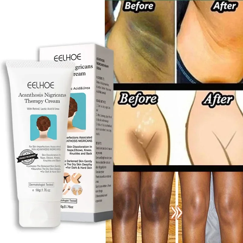 

Remove Melanin Whitening Cream Moisturizing Repair Black Acanthoderma Skin Lotion Brighten Private Parts Body Whiten Care Cream