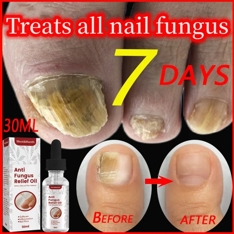 

West&Month Nailr Fungal Treatment Feet Care Essence Anti Infection Paronychia Onychomycosis Toe Nail Fungus Removal Gel