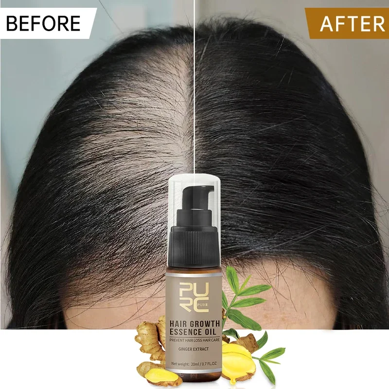 

Имбирное масло для волос PURC, средство против выпадения волос, масло с эссенцией для лечения кожи головы для мужчин и женщин, профессиональные средства по уходу за волосами