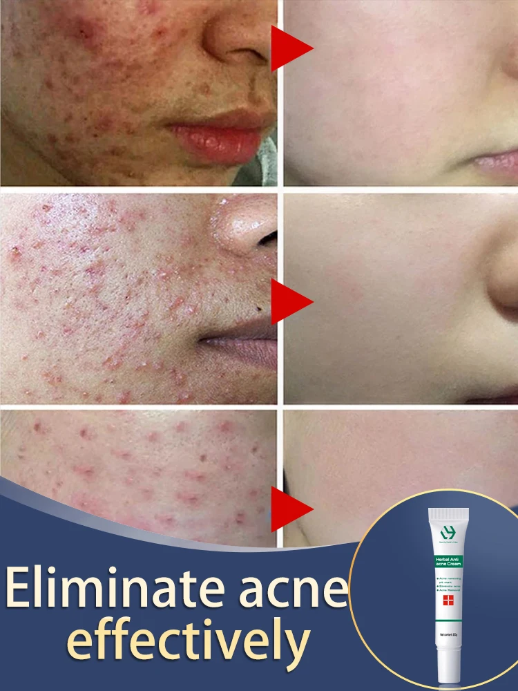 

Acne Face Cream Herbal Pimple Scar Removal Shrink Pore Oil Control Moisturizing Facial Cream Acne Treatment Skin Care