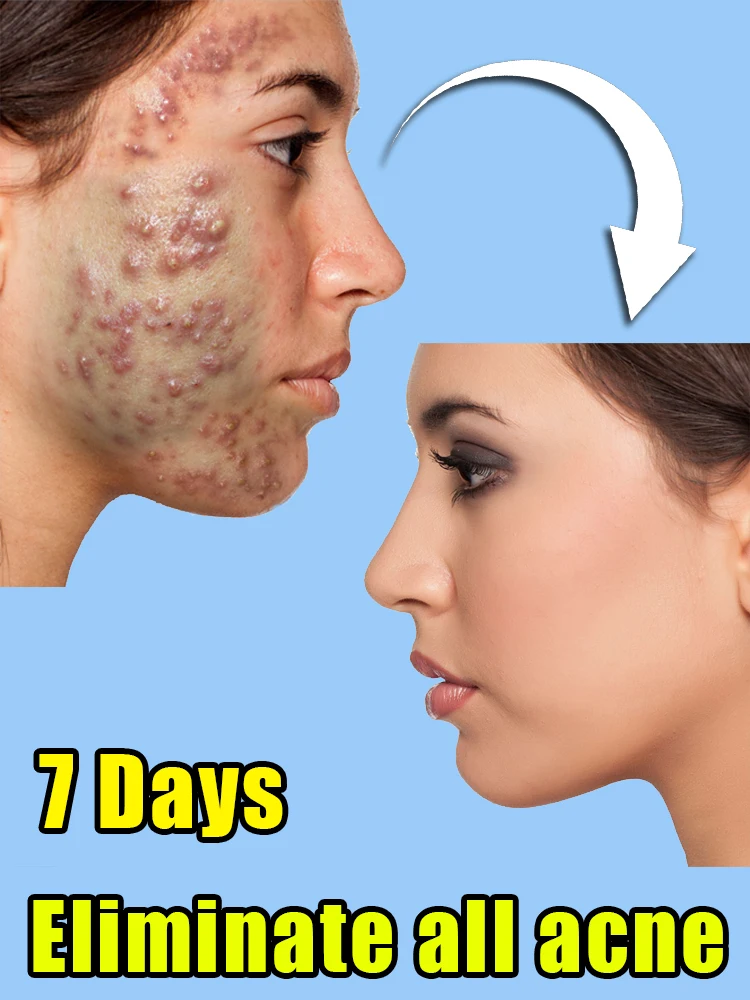 

Acne Face Cream Herbal Pimple Scar Removal Shrink Pore Oil Control Moisturizing Facial Cream Acne Treatment Skin Care