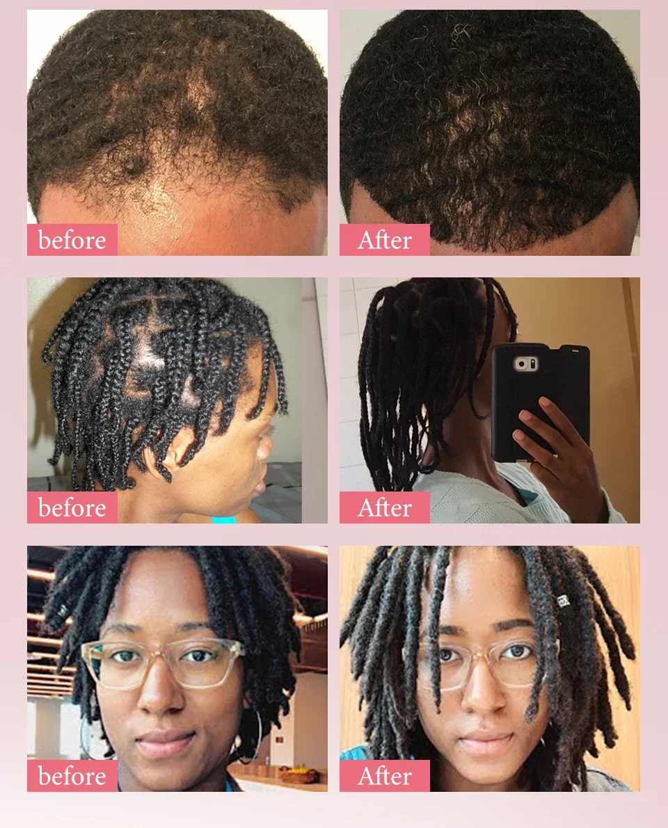 Fast Hair Growth Set Batana Oil Traction Alopecia HairS Mask Anti Break Loss Hair Growth Oil Baldness Treatment Hair Health Care 17 S6d46f88fc9654db6b33312e5c30cc1e9z