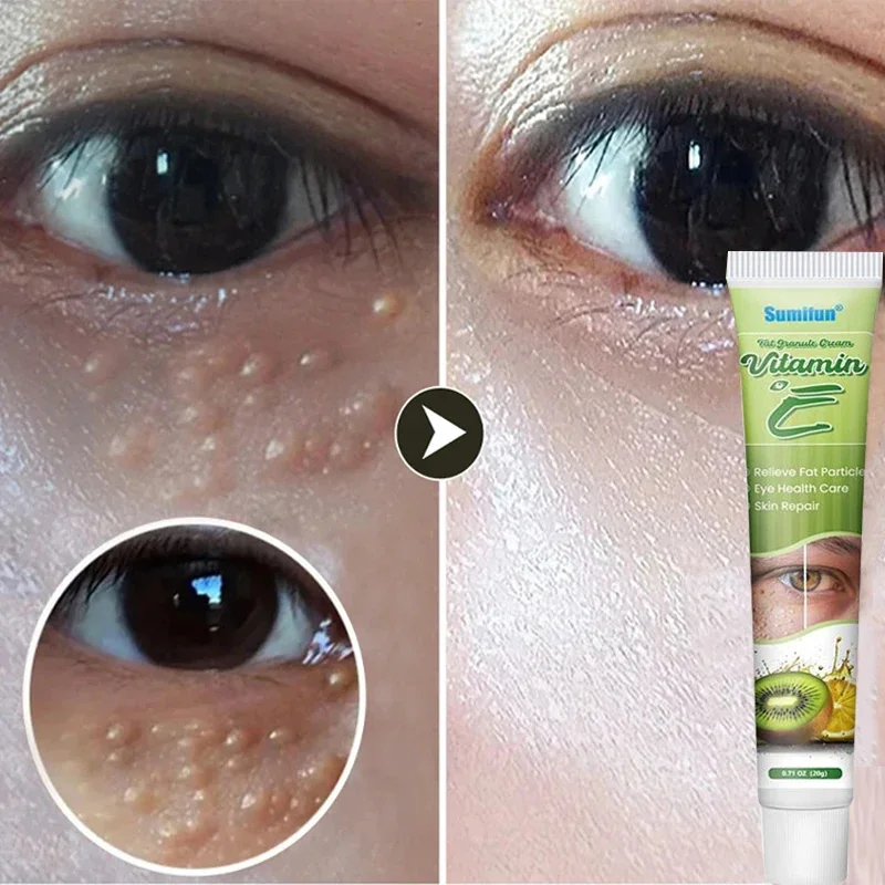 Fat Granules Remover Eye Cream Effective Remove Fat Granules Puffiness Anti-Particles Milia Remover Product Repair Eye Skin Care
Fat Granules Remover Eye Cream Effective Remove Fat Granules Puffiness Anti-Particles Milia Remover Product Repair Eye Skin Care