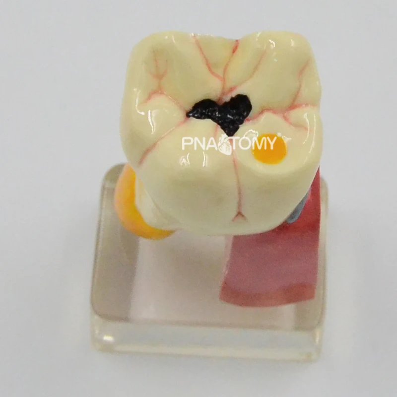 Enlarged Diseased Teeth Model Saprodontia Decayed Tooth Dental Nerve Oral Anatomical Model Educational Equipment Teaching Tool
Enlarged Diseased Teeth Model Saprodontia Decayed Tooth Dental Nerve Oral Anatomical Model Educational Equipment Teaching Tool