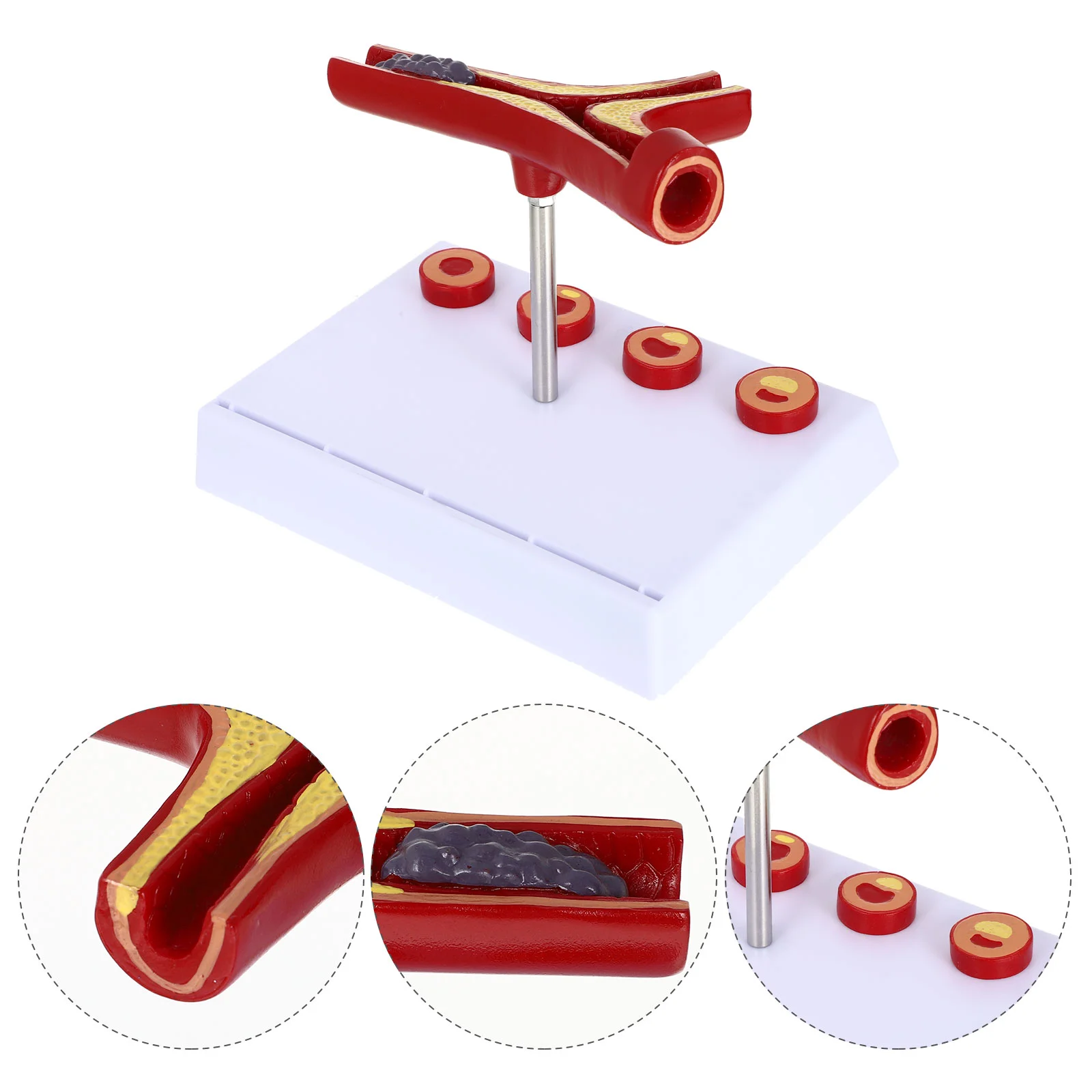 

Model Atherosclerosis Cardiovascular Human Display Blood Vessel Teaching Anatomical Models Medical Tool Vaccumeseal Vascula