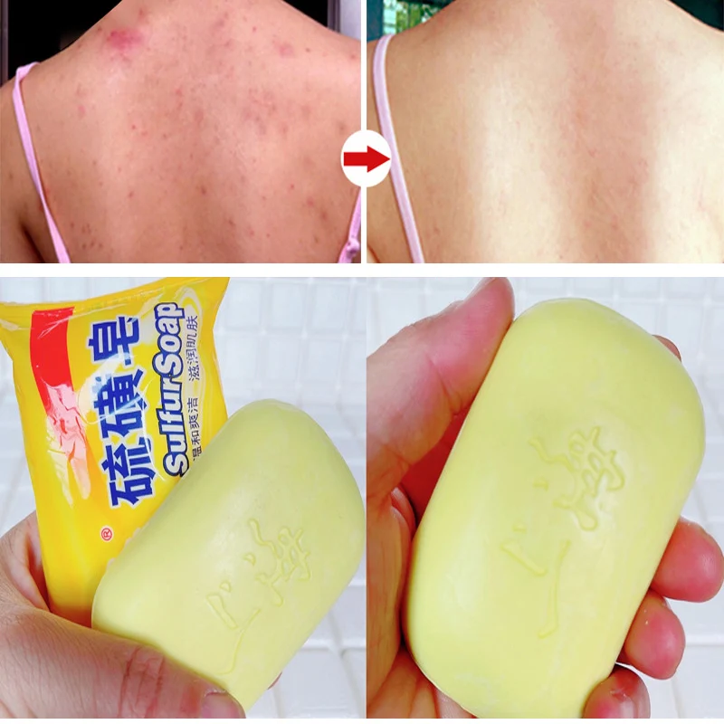 Sdotter 85g Shanghai Sulfur Soap Oil-Control Acne Treatment Psoriasis Seborrhea Eczema Anti Fungus Bath Healthy Soaps Eczema
Sdotter 85g Shanghai Sulfur Soap Oil-Control Acne Treatment Psoriasis Seborrhea Eczema Anti Fungus Bath Healthy Soaps Eczema