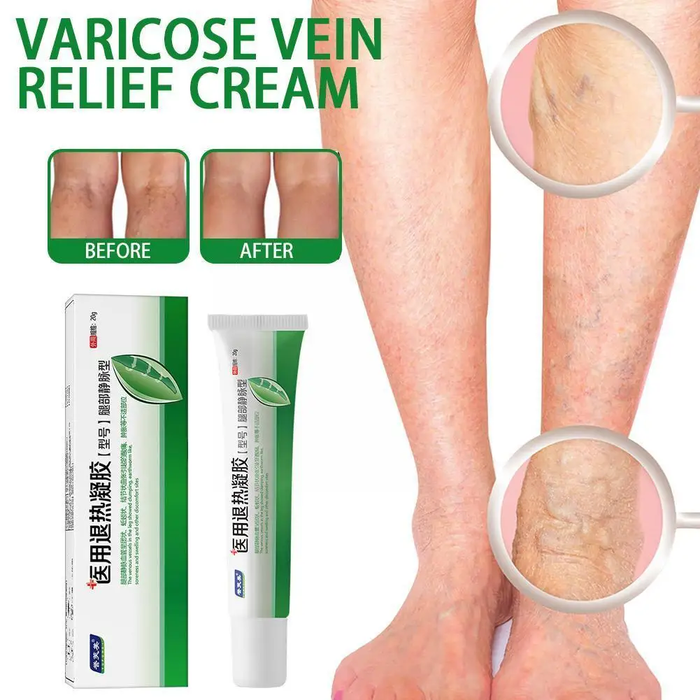 

New Potent Formula Ointment For Varicose Veins Effective Varicose Vein Relief Cream To Relieve Vasculitis Phlebitis Spider F5F4