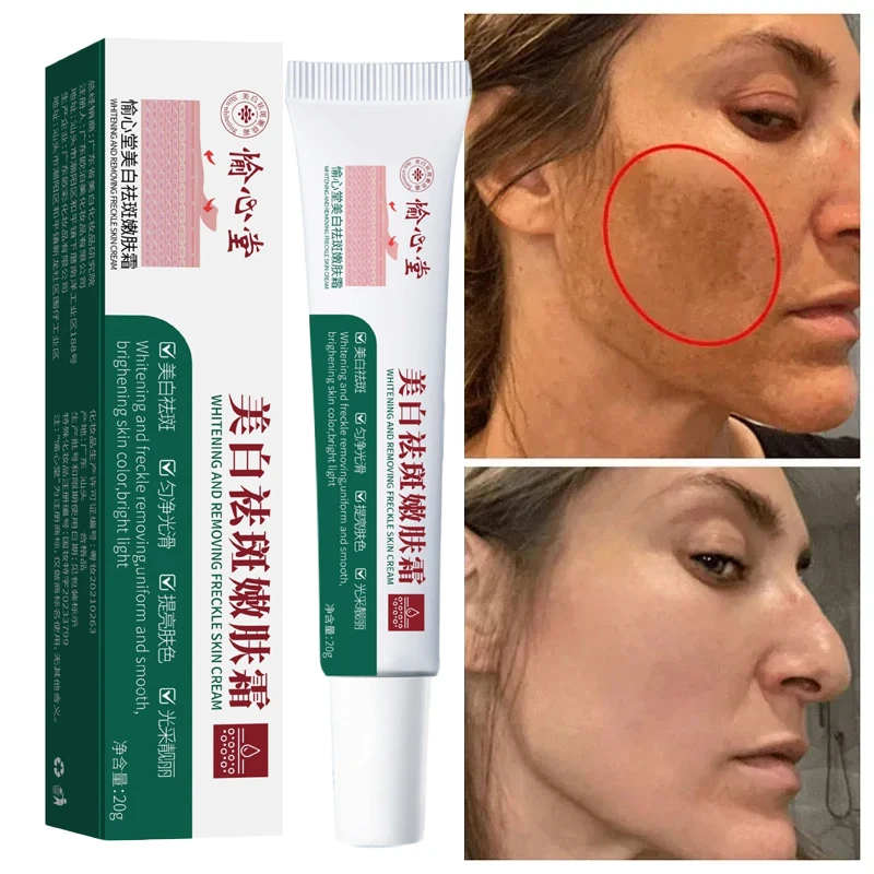 Whitening Freckle Cream Melasma Dark Spots Pigmentation Removal Products Fade Stain Melanin Repair Brighten Korean Skin Care
Whitening Freckle Cream Melasma Dark Spots Pigmentation Removal Products Fade Stain Melanin Repair Brighten Korean Skin Care