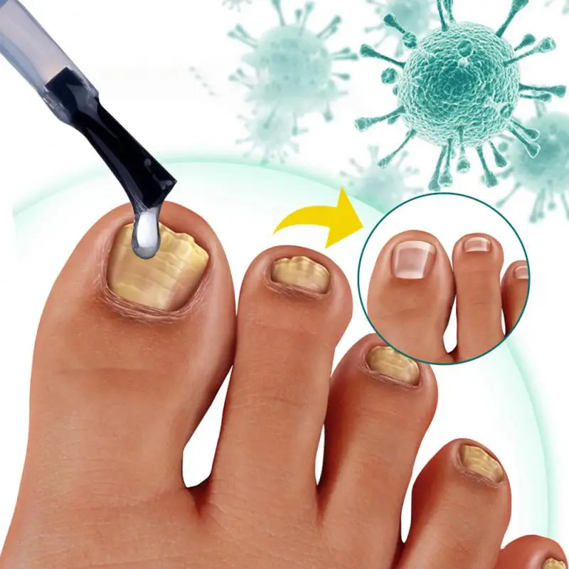Nail Fungal Treatment Feet Care Surem AntiInfection Paronychia Onychomycosis Nail Foot Toe Nail Fungus Removal Gel Product 5ml
Nail Fungal Treatment Feet Care Surem AntiInfection Paronychia Onychomycosis Nail Foot Toe Nail Fungus Removal Gel Product 5ml