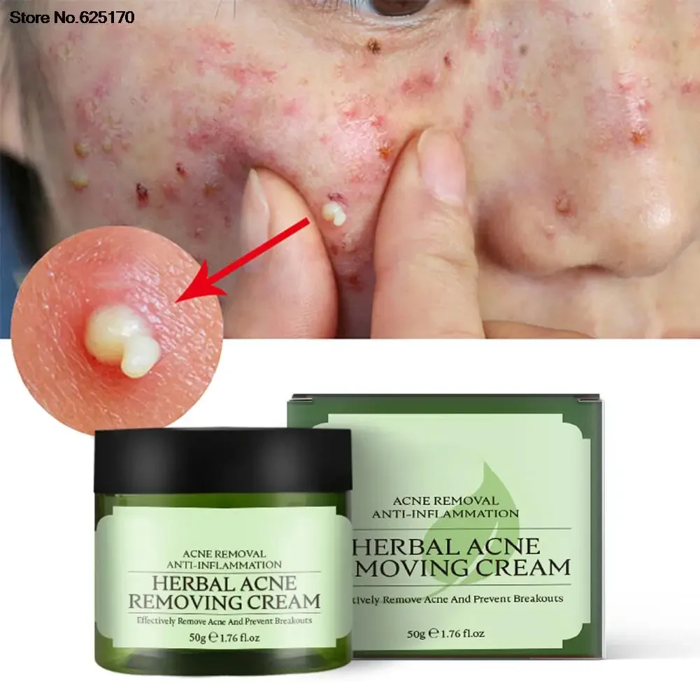50g Herbal Acne Removing Cream Prevent Breakout Natural Blend Prone Sensitive Skin Oil Control Roughness Refreshing Skin Care
50g Herbal Acne Removing Cream Prevent Breakout Natural Blend Prone Sensitive Skin Oil Control Roughness Refreshing Skin Care