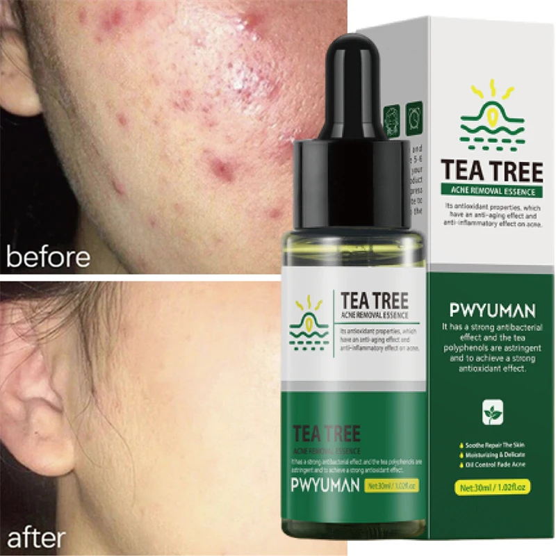 

Tea Tree Acne Treatment Serum Repair Dark Spots Scar Removal Pimples Shrink Pores Anti-Acne Oil Control Moisturizing Skin Care