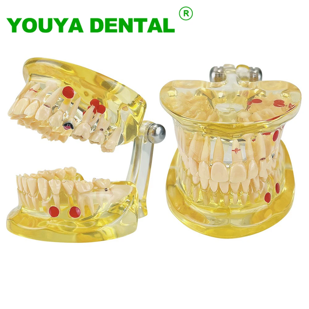 Dental Teaching Study Model With Half-Detachable Tooth Medical Science Disease Dentistry Pathological Model Dental Products
Dental Teaching Study Model With Half-Detachable Tooth Medical Science Disease Dentistry Pathological Model Dental Products