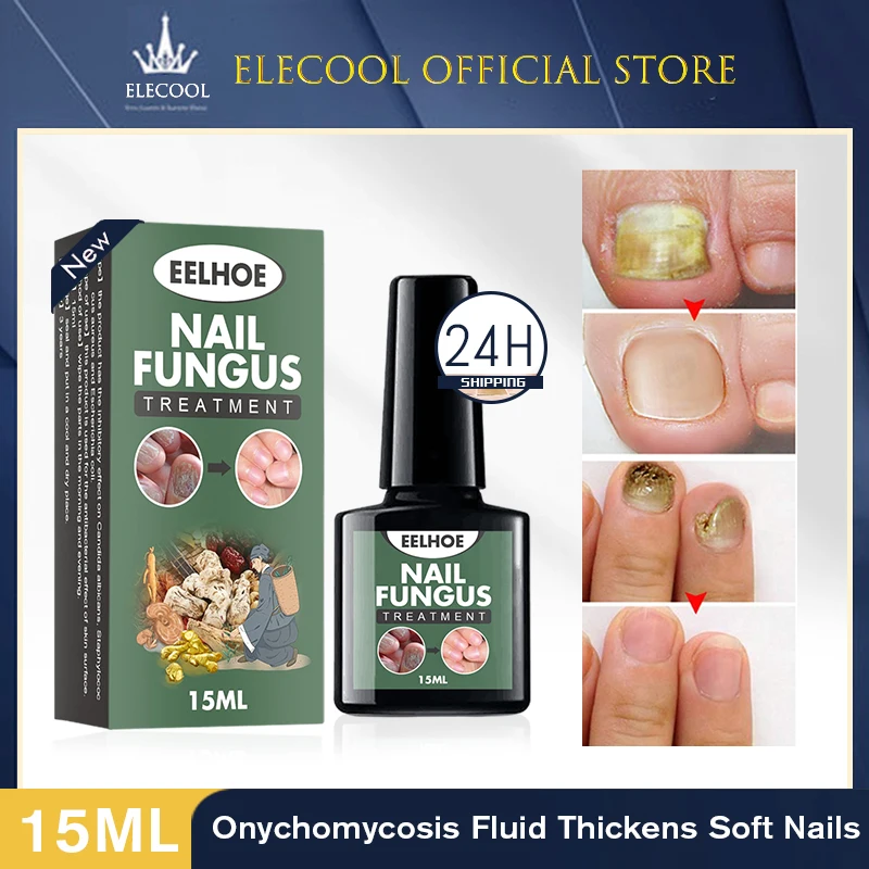 ELECOOL Nail Fungal Treatment Feet Care Essence Foot Toe Fungus Removal Gel Anti Infection Paronychia Onychomycosis | Красота и
