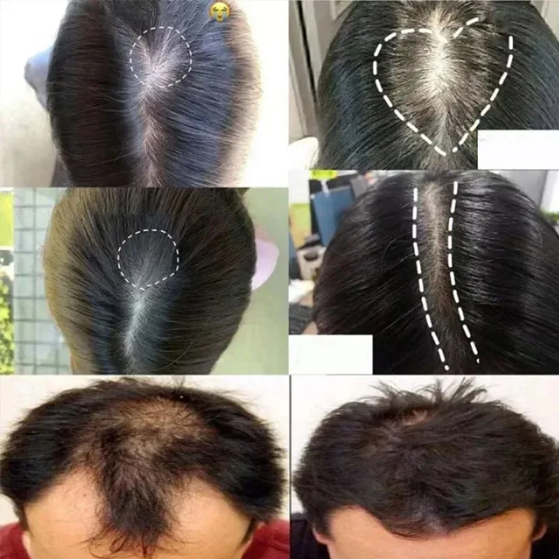 Fast Hair Growth Set Batana Oil Traction Alopecia HairS Mask Anti Break Loss Hair Growth Oil Baldness Treatment Hair Health Care 11 S800fbf8044e94126a355a6f2e35371e0P