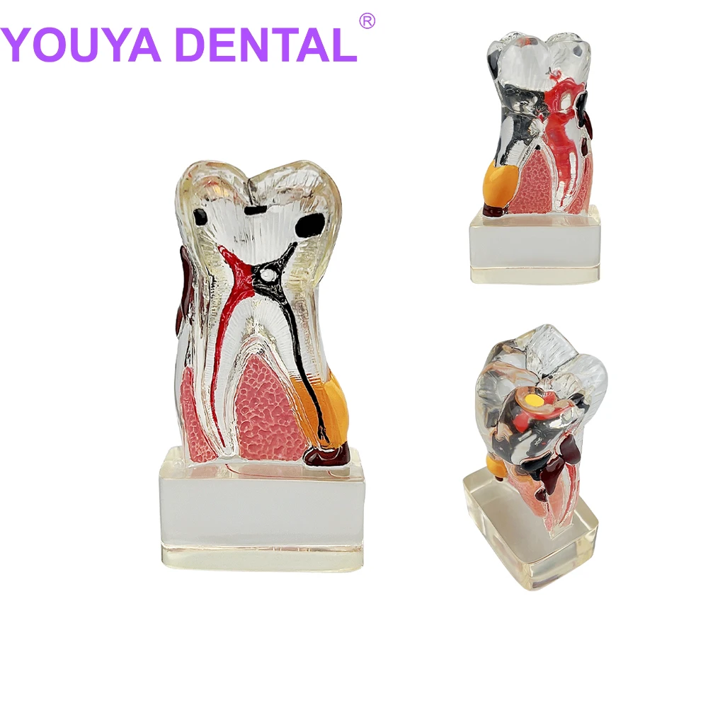 Dental Anatomical Model Transparent Single Tooth Decomposition Model Dentistry Teeth Molar Periodontal Disease Demonstration Too
Dental Anatomical Model Transparent Single Tooth Decomposition Model Dentistry Teeth Molar Periodontal Disease Demonstration Too