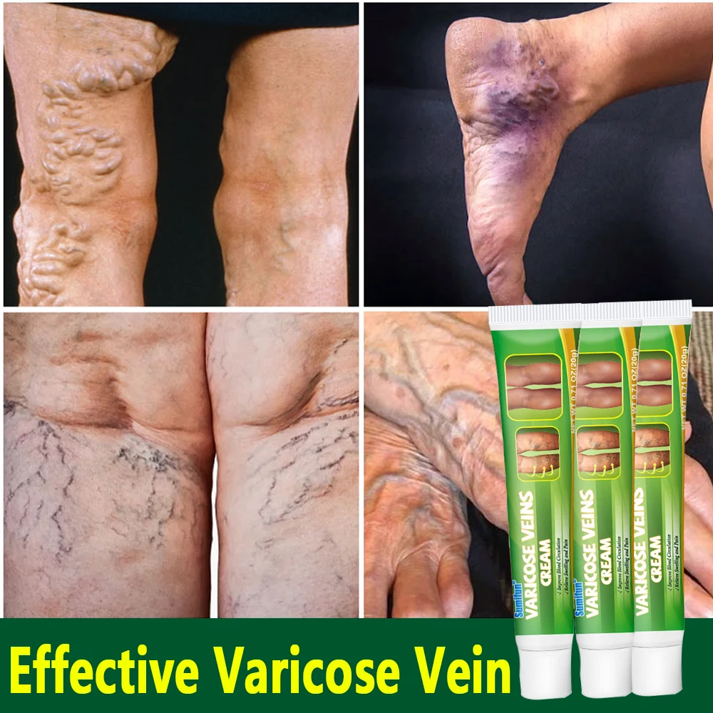 

Effective Varicose Vein Treatments Cream Relieve Legs Dilated Vasculitis Phlebitis Natural Formula Ointment for Varicose Veins