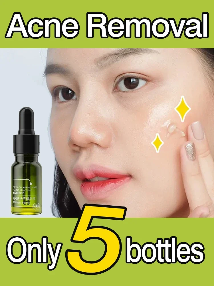 Acne Removal serum Acne-removing oil Improve Acne Pimple Moisturizer face Repair oil Control Skin Care Products
Acne Removal serum Acne-removing oil Improve Acne Pimple Moisturizer face Repair oil Control Skin Care Products