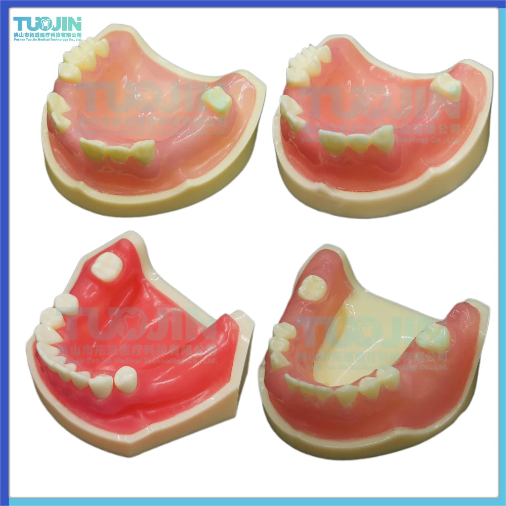 TJ Dental Implant Mandibular Jaw Teeth Model Overdenture Implant Tooth Model Dentist Orthodontic Model Demonstration Teaching
TJ Dental Implant Mandibular Jaw Teeth Model Overdenture Implant Tooth Model Dentist Orthodontic Model Demonstration Teaching
