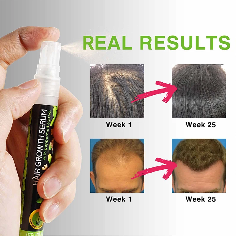 

Имбирная Сыворотка для роста волос, против выпадения волос, эфирное масло, лечение волос, истончение, сухая сыворотка для восстановления волос, натуральный имбирный спрей