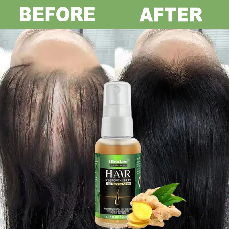 Ginger Hair Growth Serum Products For Men Women Hair Loss Treatment Fast Growing Spray Thicken Regrowth Hair Oil Care Beauty New
Ginger Hair Growth Serum Products For Men Women Hair Loss Treatment Fast Growing Spray Thicken Regrowth Hair Oil Care Beauty New