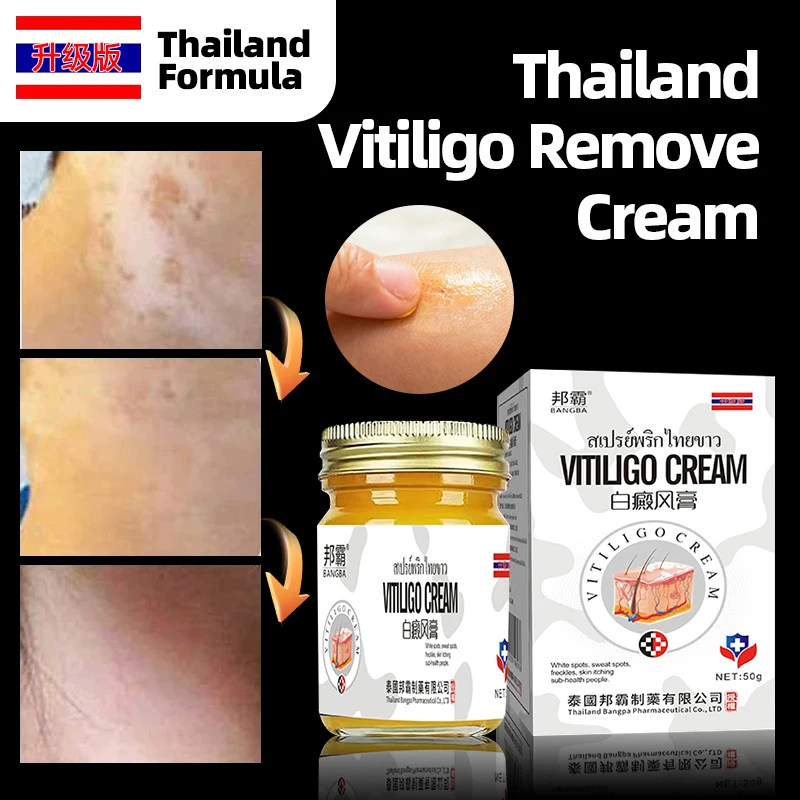 

Крем для ухода за кожей Vitiligo, средство для удаления белых пятен, удаление лейкоплакии ног, восстановление меланина, медицина, тайская формула