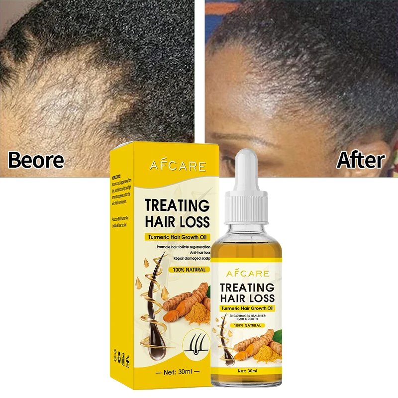 

Strong Effect Turmeric Hair Growth Products Ginger Essential Oil 2 Week Treat Hair Loss Scalp Repair Nourish Hair Roots Regrowth
