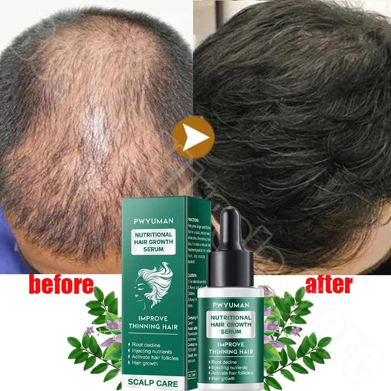 Ginger Hair Growth Product Anti-loss Hair Regrowth Serum Oil Fast Grow Prevent Baldness Treatment Alopecia Men Women Hair Care
Ginger Hair Growth Product Anti-loss Hair Regrowth Serum Oil Fast Grow Prevent Baldness Treatment Alopecia Men Women Hair Care